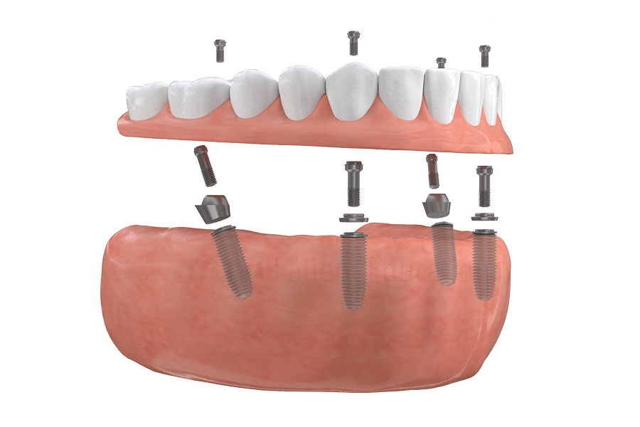 Dental Implants