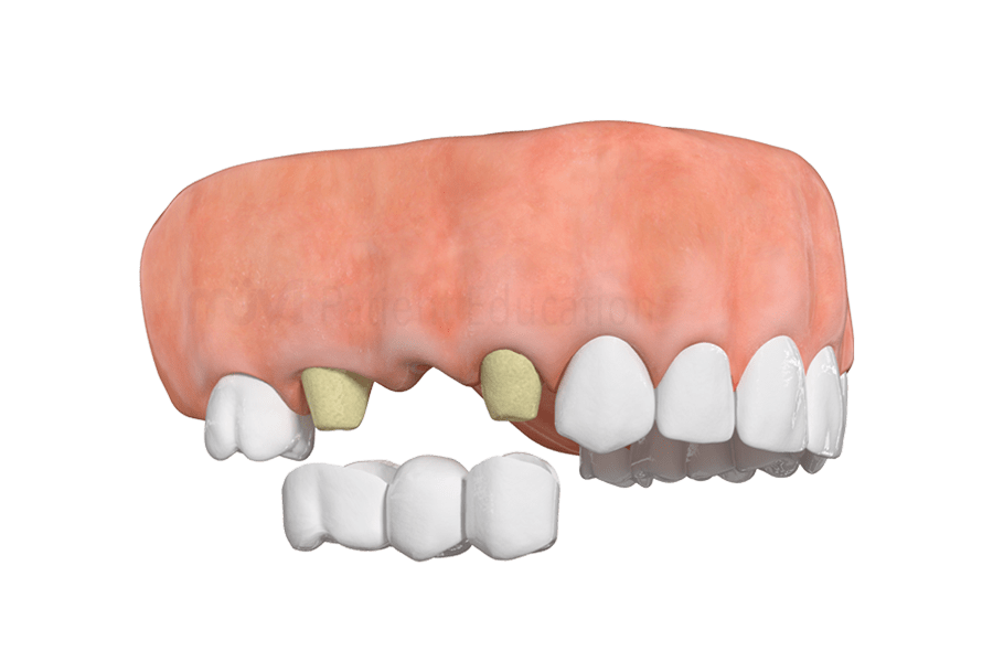 Dental Bridge